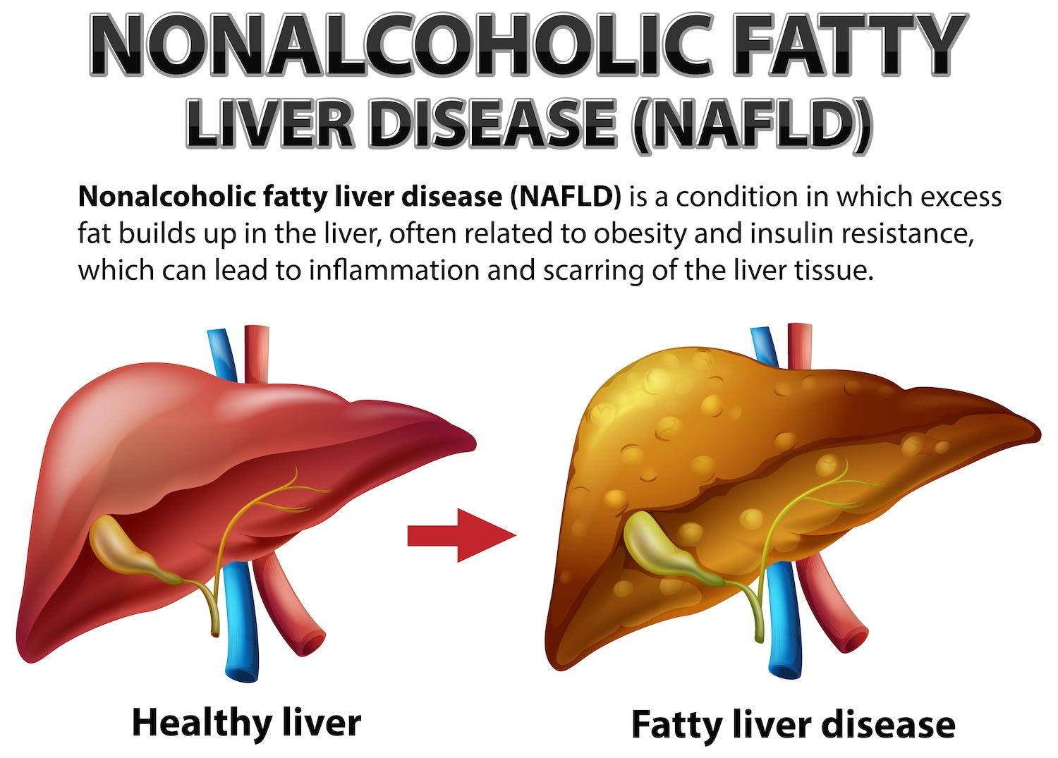 NAFLD Non Alcoholic Fatty Liver Disease and the Role of Our Test ...