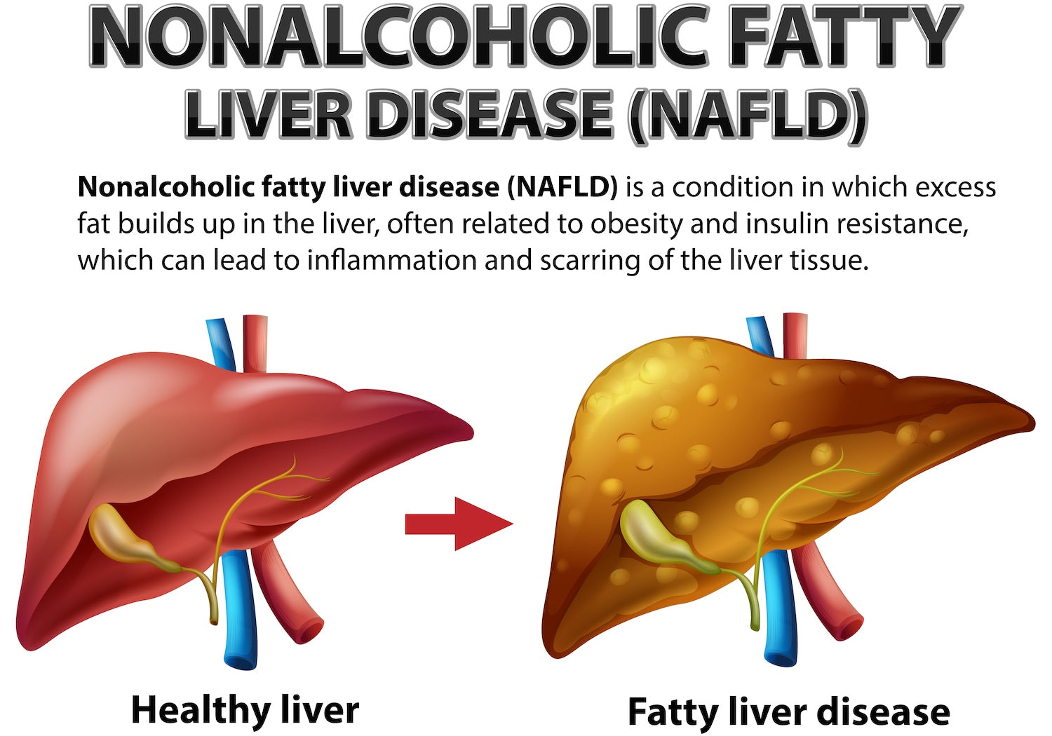 NAFLD (Non-Alcoholic Fatty Liver Disease) and the Role of Our Test in Monitoring Your Health